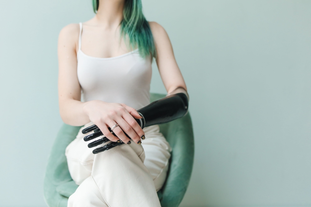 Jonge vrouw met prothese arm